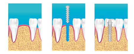 implant dentaire Rouen 